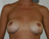 Feel Beautiful - Breast Revision San Diego 4 - Before Photo